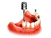 �I�[���I���t�H�[��ĂB�I�[���I���t�H�[�̓I�y�̓��ɓ���܂��B