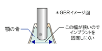 GBR�C���[�W�ł��B���̕��⍂��������Ȃ��ƃC���v �����g�𖄂ߍ��߂܂���B�f�a�q�@���g���΍��𑝂₷���Ƃ��ł��܂��B
