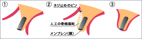 �f�a�q�̃C���[�W�ł��B���̌��ɂȂ�זE���W�߂܂��B�����Ȃ��ꍇ�ɁA���ɗL���ł��B�������A�ŋ߂͂f�a�q�@�����Ȃ��Ă����𑝂₷���Ƃ��ł��܂��B�P�[�X�o�C�P�[�X�Ŏg���܂��B