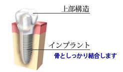 骨としっかり結合します。