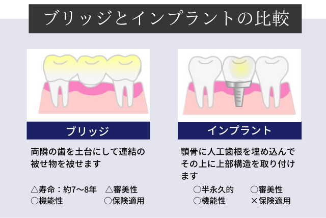 ブリッジとインプラントの比較