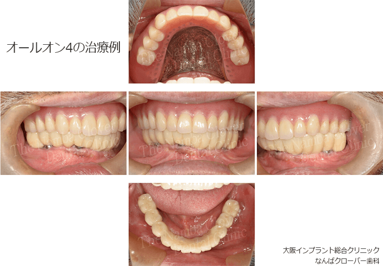 オールオン4の治療例