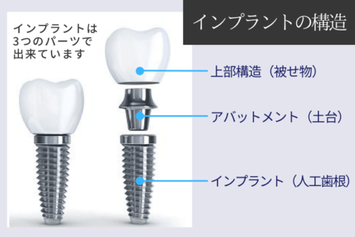 インプラントの構造