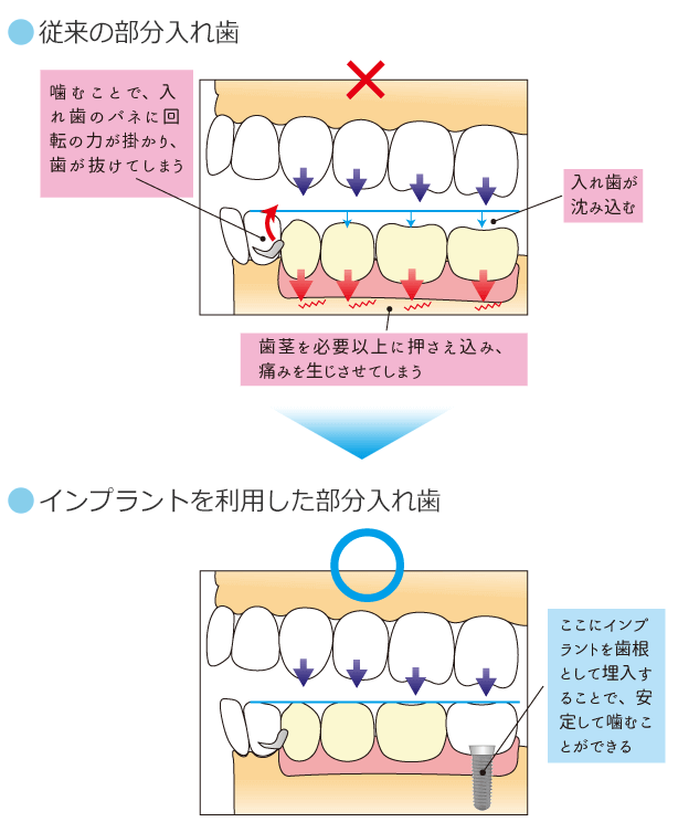 通常の部分入れ歯とインプラントを利用した部分入れ歯