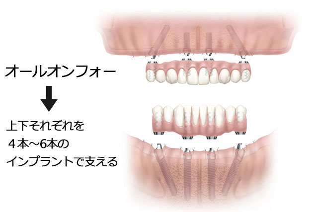 オールオンフォーは4～6本のインプラントで支える