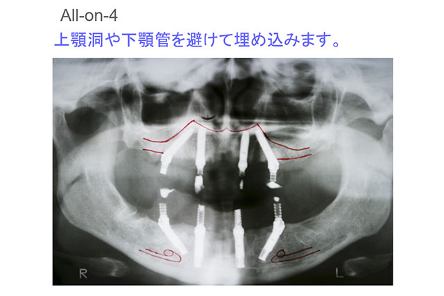 インプラントを斜めに埋め込みます