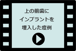 上の前歯にインプラントを埋入した症例