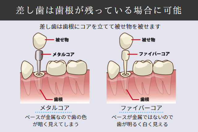 差し歯の説明