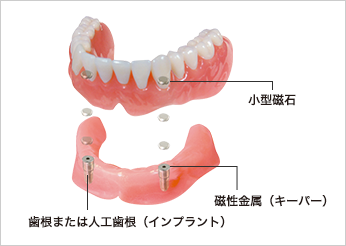 磁石式義歯