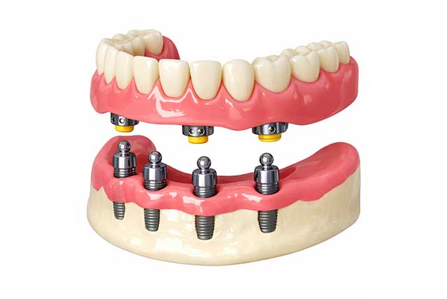 インプラントオーバーデンチャー