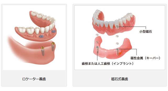 インプラントオーバーデンチャー