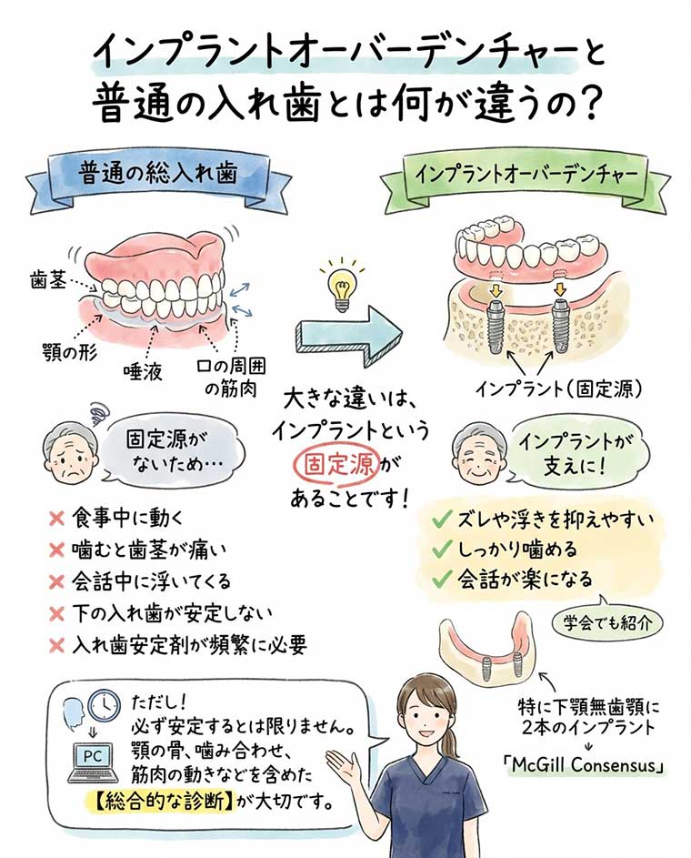 インプラントオーバーデンチャーと普通の入れ歯とは何が違うの？の図解