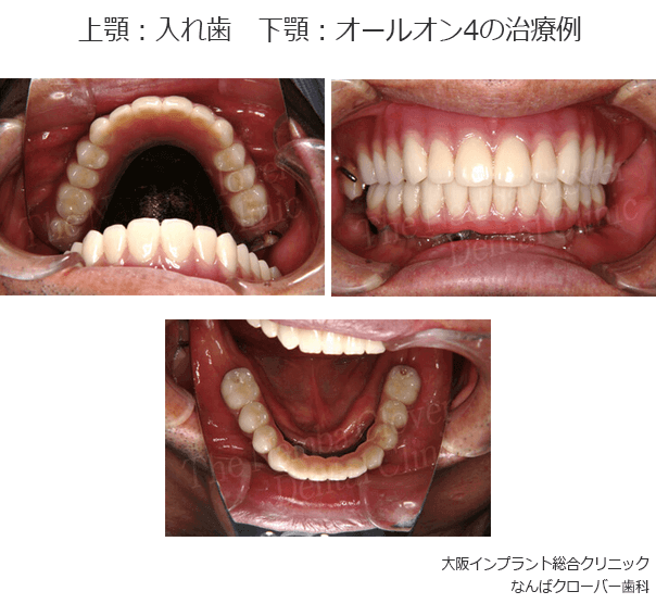 オールオン4の治療例