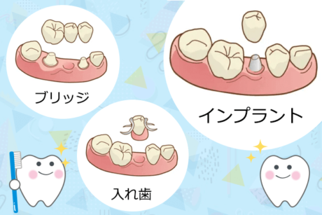 インプラント、ブリッジ、入れ歯