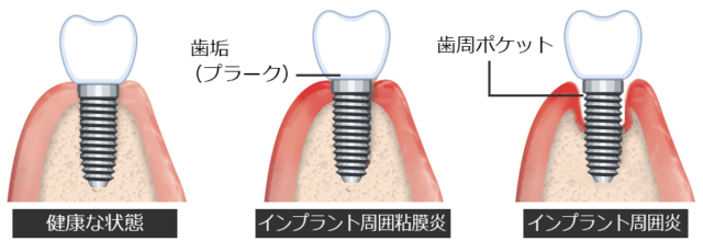 インプラント周囲炎