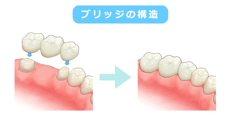 ブリッジの構造