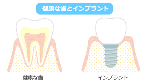 健康な歯とインプラント