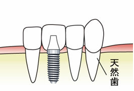 インプラント1本埋入