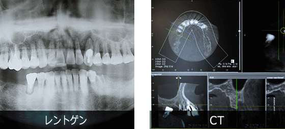 インプラントの検査　レントゲンとCT