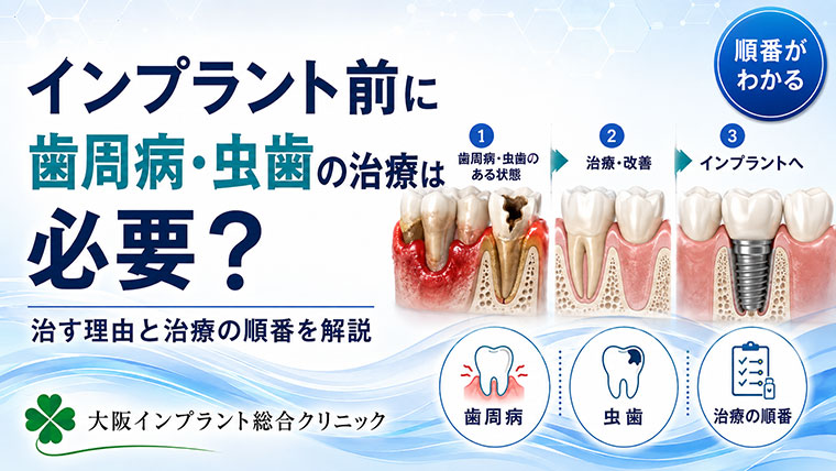 インプラント前に虫歯・歯周病の治療は必要？治す理由と治療の順番を解説