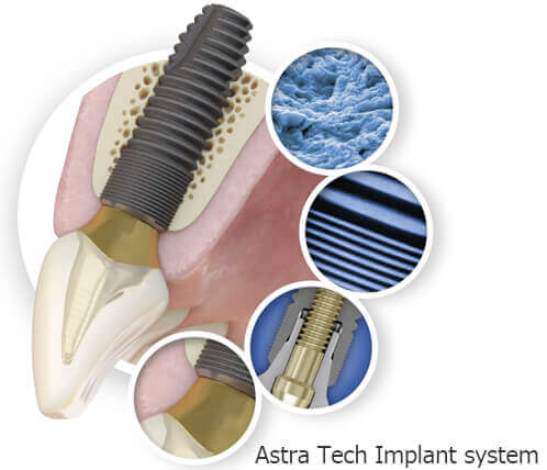 Astra Tech Implant system