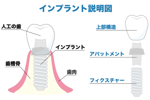 インプラント説明図