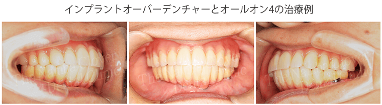 インプラントオーバーデンチャーとAll-on-4の治療例