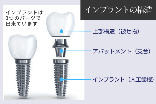 インプラントの構造