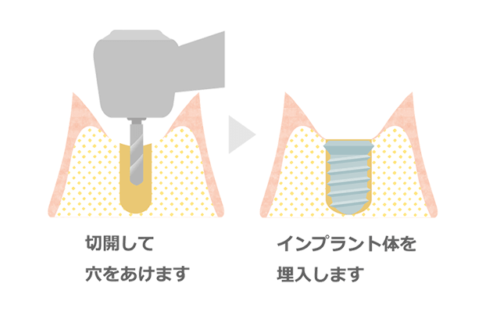 歯茎を切開し穴を開け、インプラントを埋め込みます