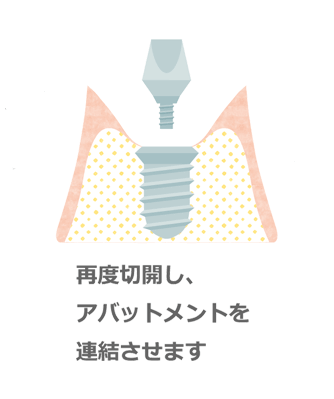 再度切開し、アバットメントを連結させます