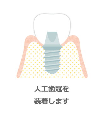 上部構造を装着します