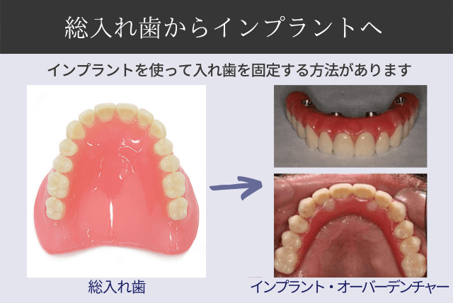 総入れ歯からインプラントへ