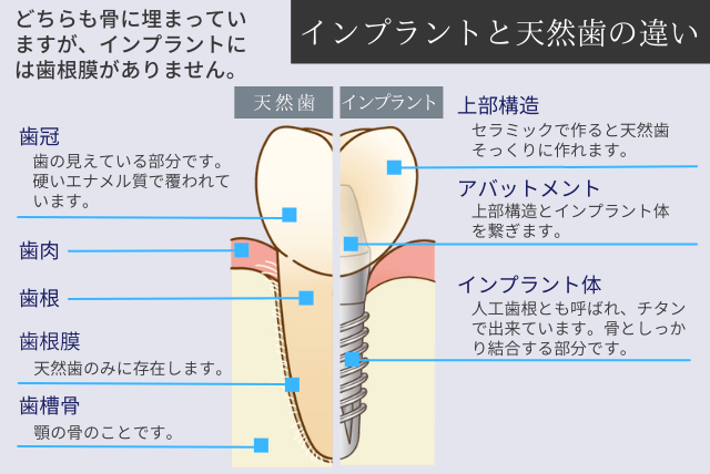 インプラントと天然歯の違い