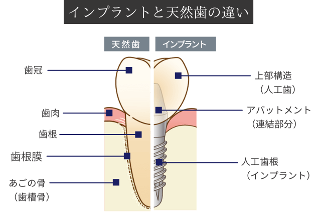 インプラントと天然歯の違い