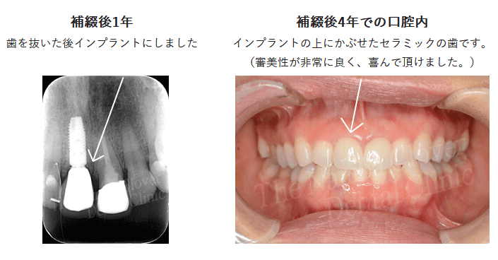 骨移植後に前歯にインプラントを埋入