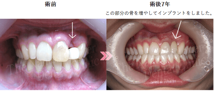 骨移植後前歯にインプラントを埋入