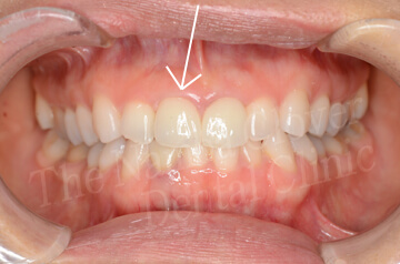 前歯のインプラント