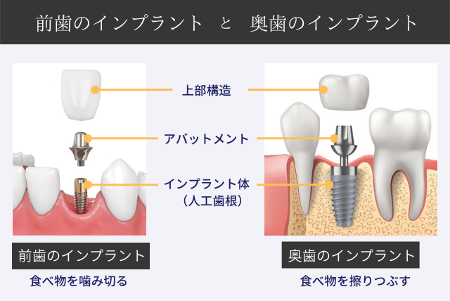 前歯のインプラントと奥歯のインプラント