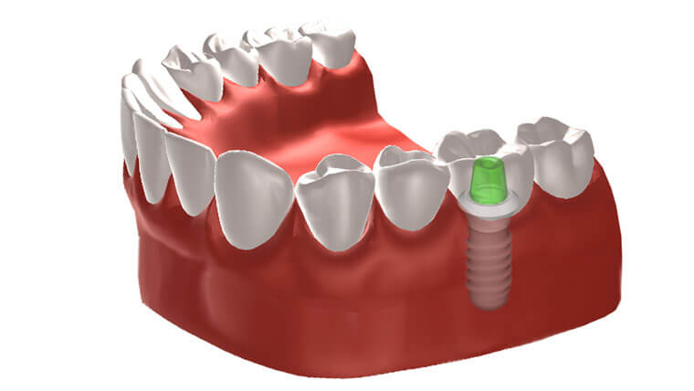 インプラントイメージ
