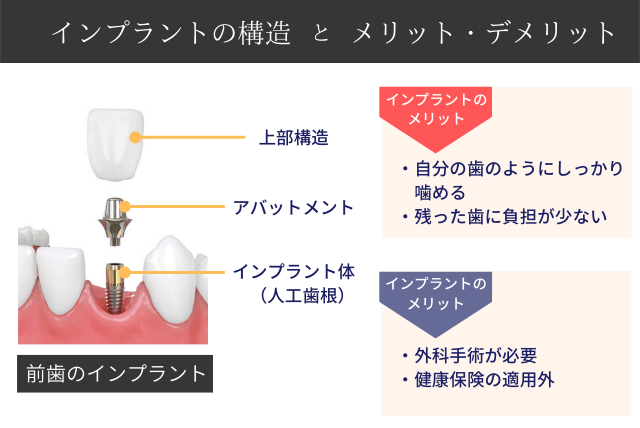 インプラントの構造とメリット・デメリット