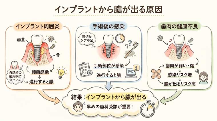 インプラントから膿が出る原因の図解