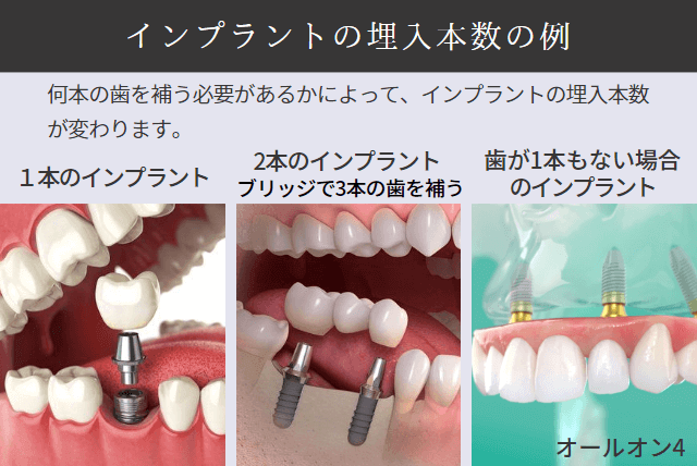 インプラントの埋入本数の例