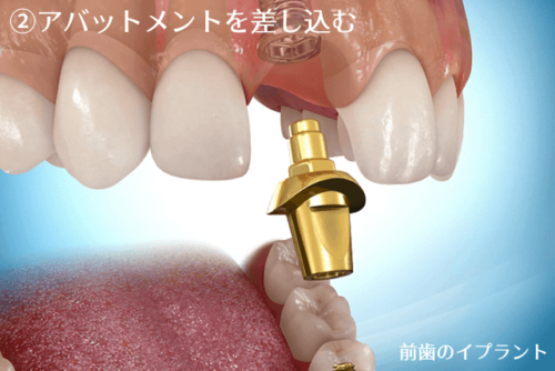 前歯のインプラント治療の流れ2