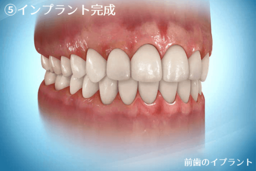 前歯のインプラント治療の流れ5