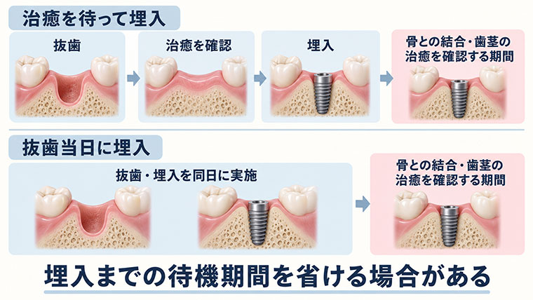 インプラント埋入のタイミング