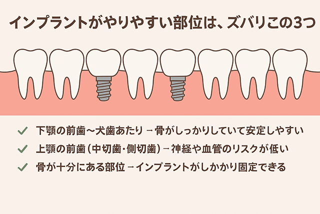 インプラントがやりやすい部位