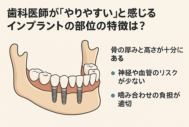 インプラントがやりやすい部位の特徴