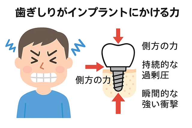 歯ぎしりはどのような力をかけるのか?