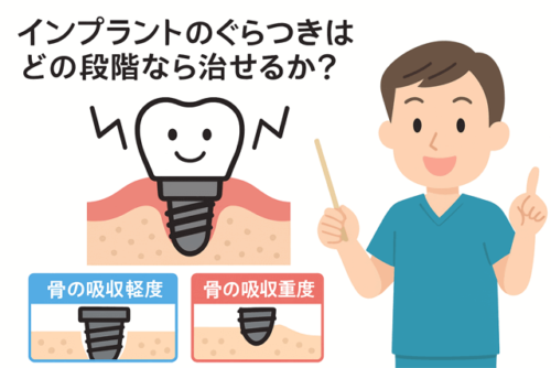 ぐらつきはどの程度なら治せるか？