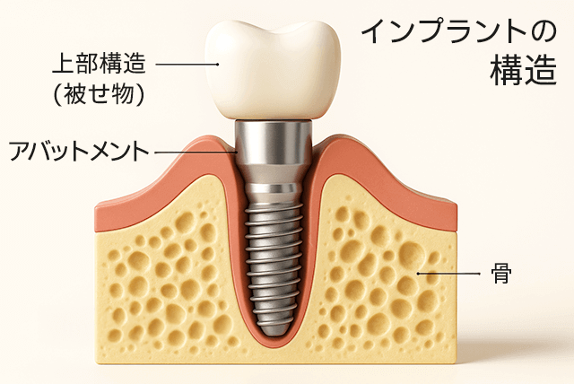 インプラントの構造